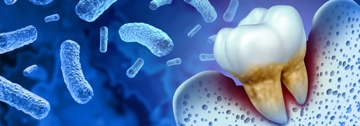 Gum Disease Treatment