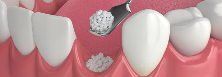 Bone Grafting for Dental Implants